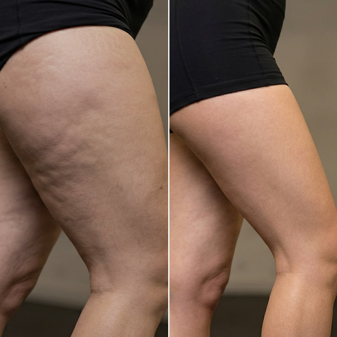 Comparação do aspeto da pele da coxa antes e depois de seguir a rotina do protocolo